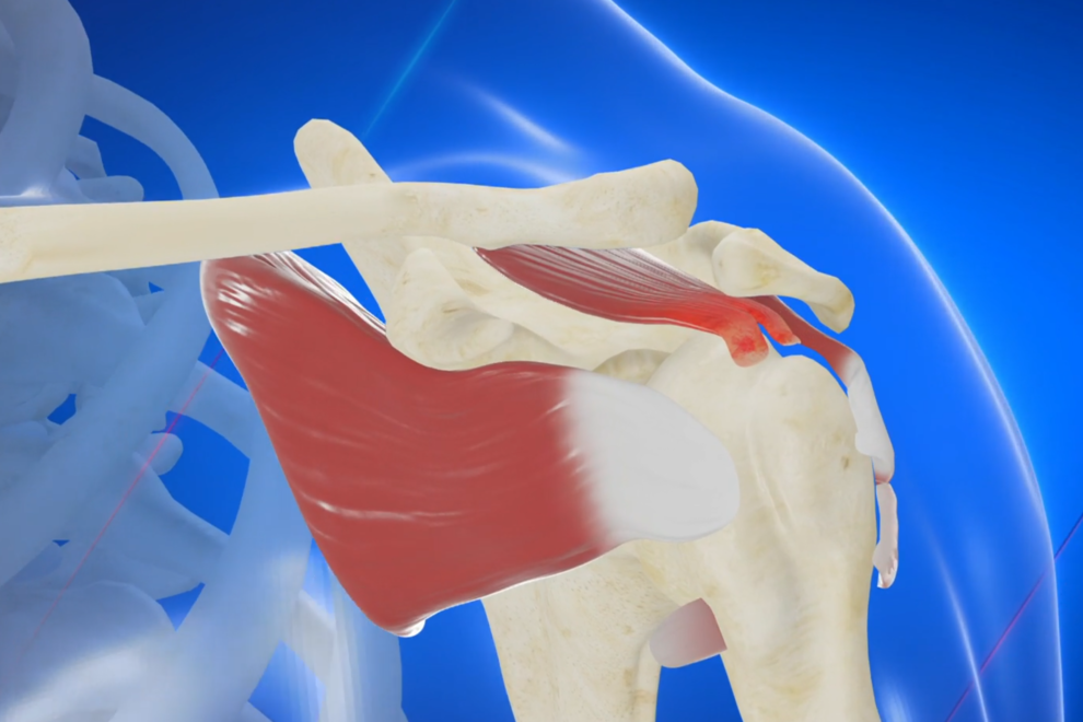 Artrosi spalla rimedi Artrosi spalla rimedi