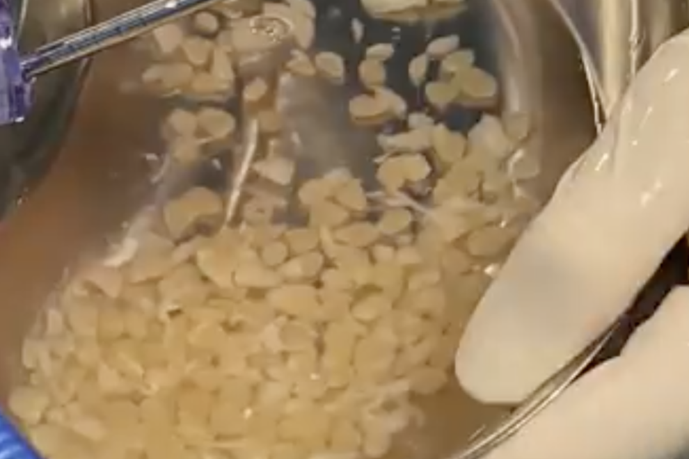 Calcificazione della cuffia dei rotatori Calcificazione della cuffia dei rotatori