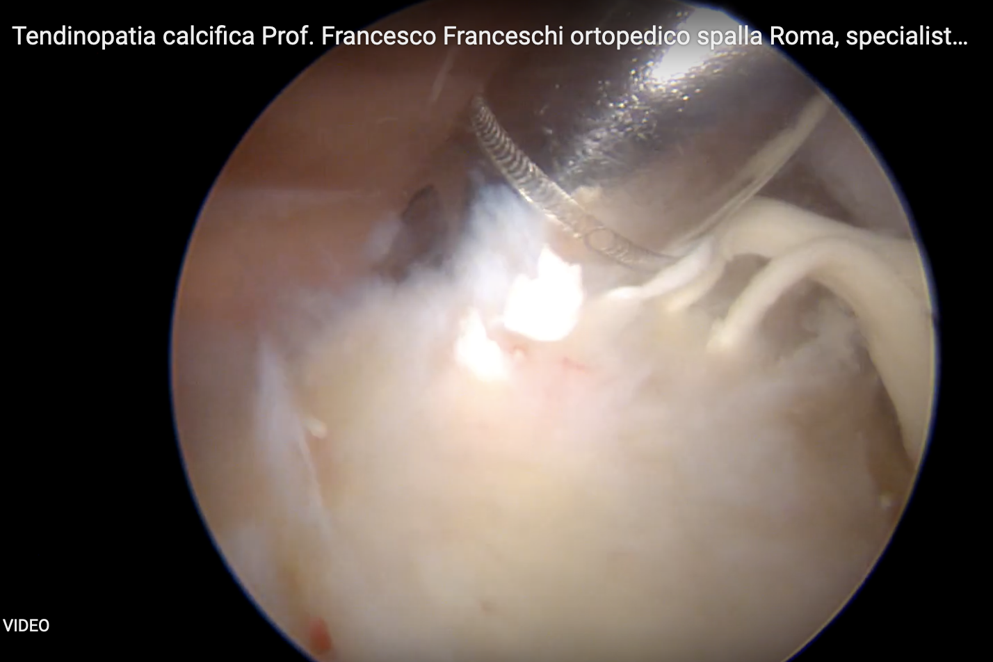 Tendinopatia calcifica