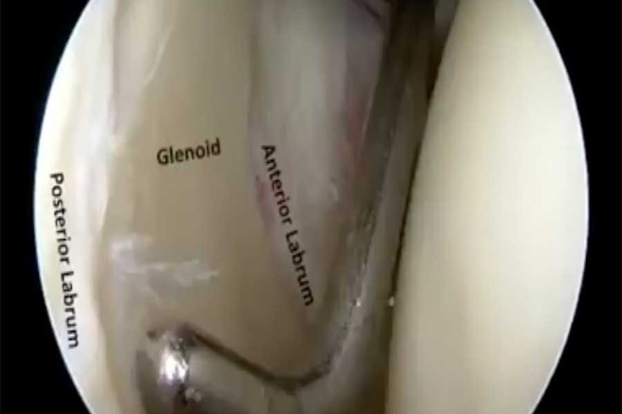 artroscopia-di-spalla artroscopia-di-spalla