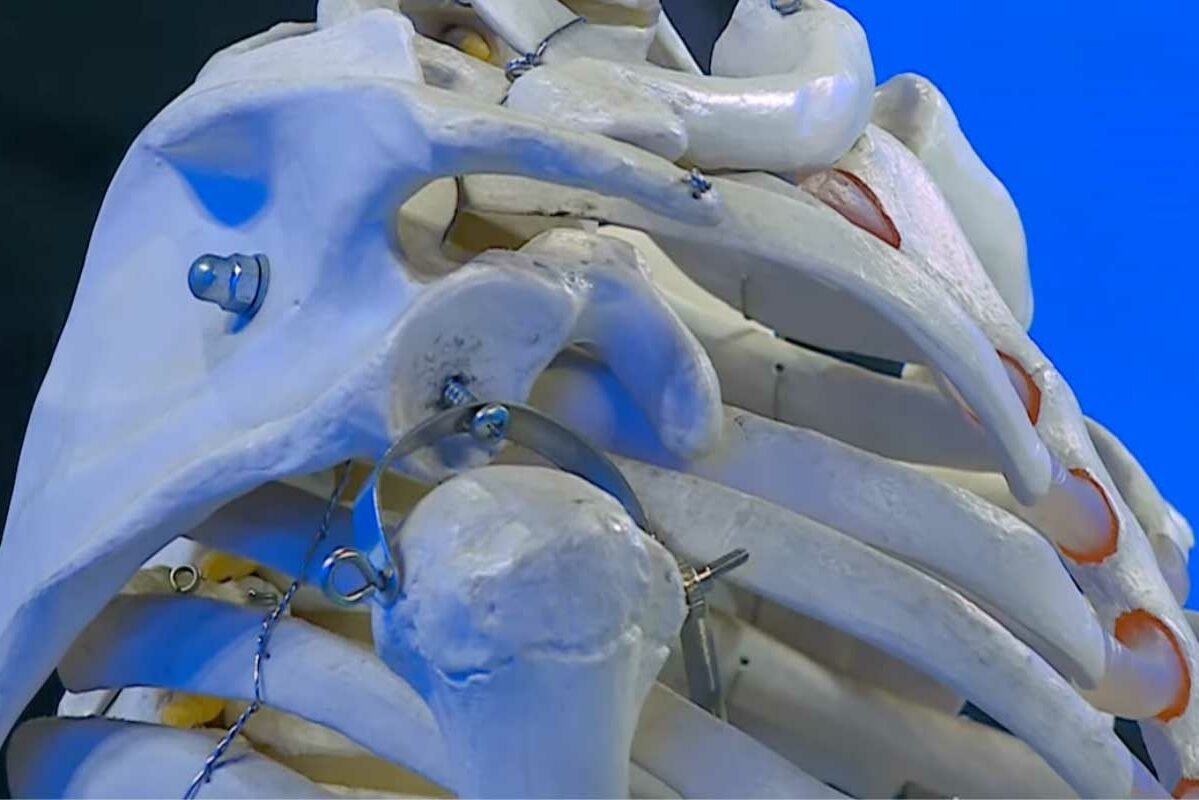 artrosi-alla-spalla_1