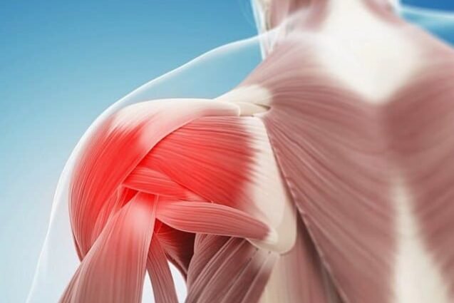 capsulite adesiva 1 capsulite adesiva 1