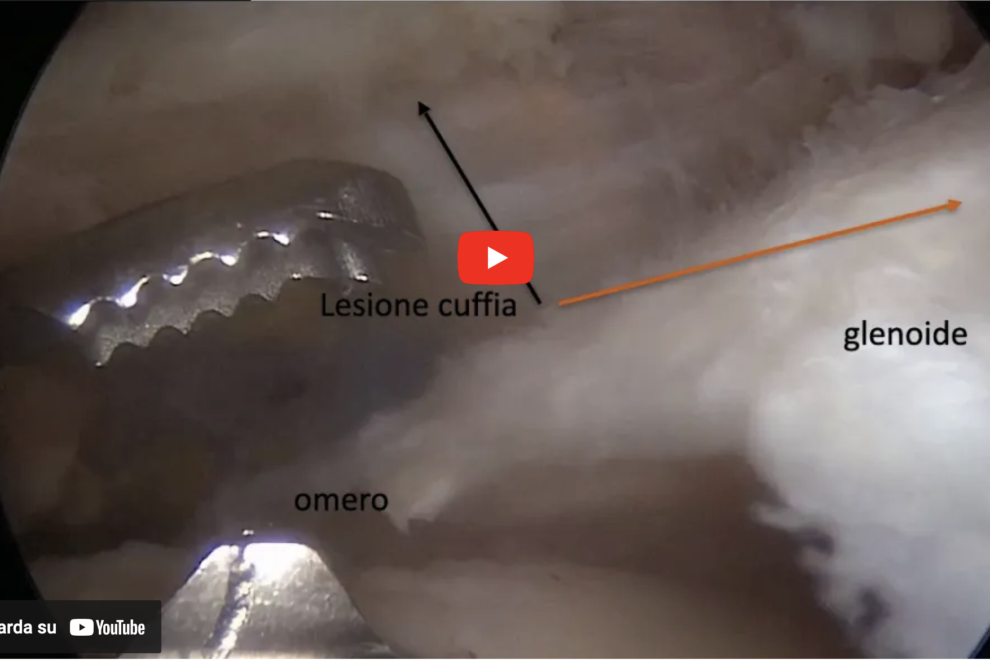 cuffia dei rotatori case history