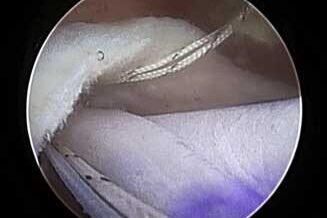 la cuffia dei rotatori