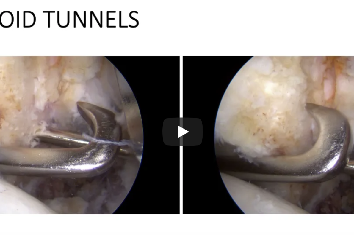 Arthro Latarjet e Remplissage