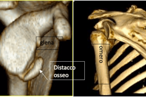 Instabilità di spalla