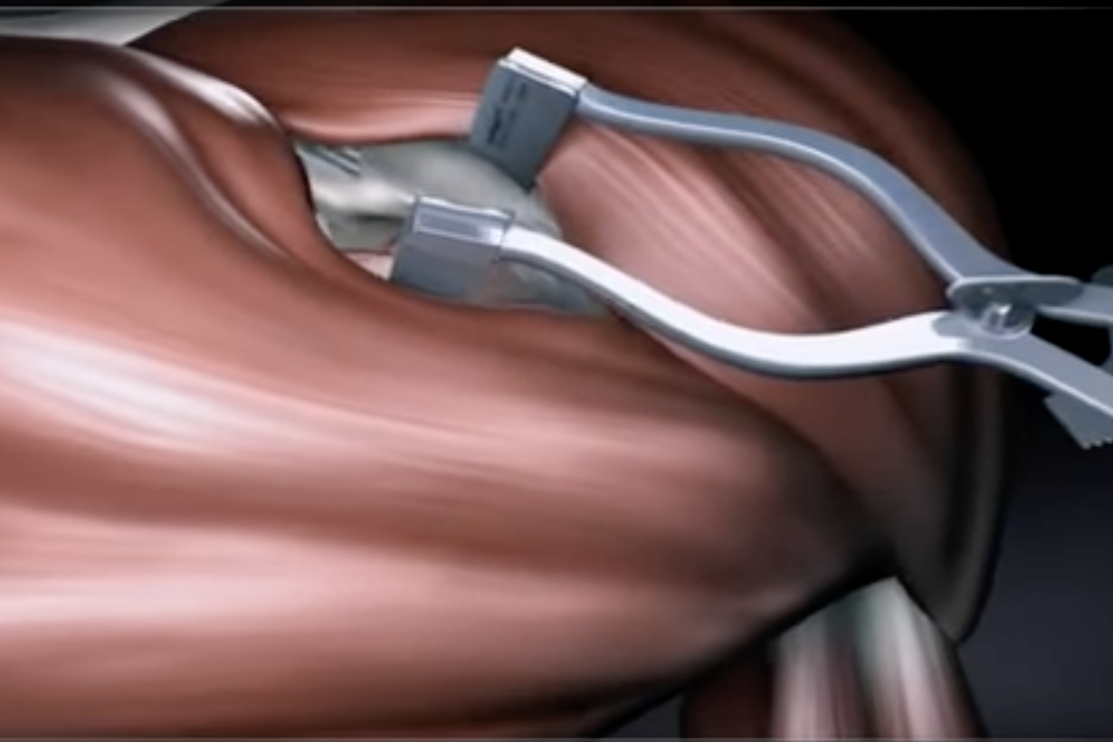 Intervento di Latarjet