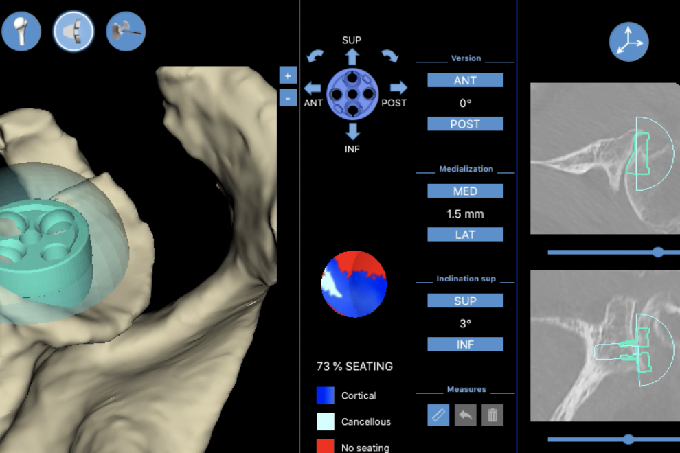 Le protesi su misura