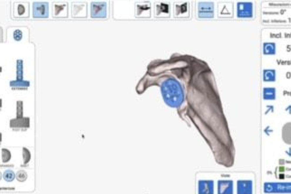 chirurgia protesica di spalla le ultime novita