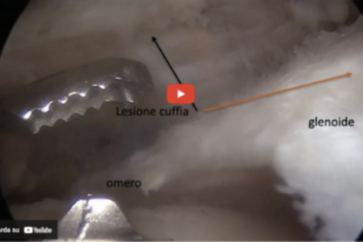 cuffia dei rotatori info intervento