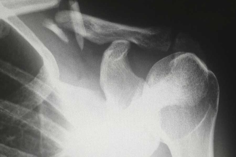 frattura-della-spalla