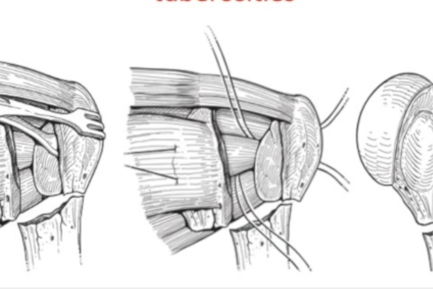 frattura prossimale dell omero