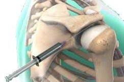 le-infiltrazioni-di-cortisone le-infiltrazioni-di-cortisone