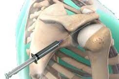 le-infiltrazioni-di-cortisone