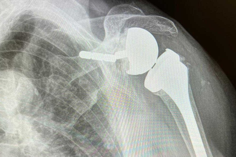 protesi-di-spalla-info-intervento