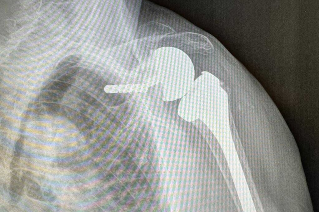 protesi inversa di spalla