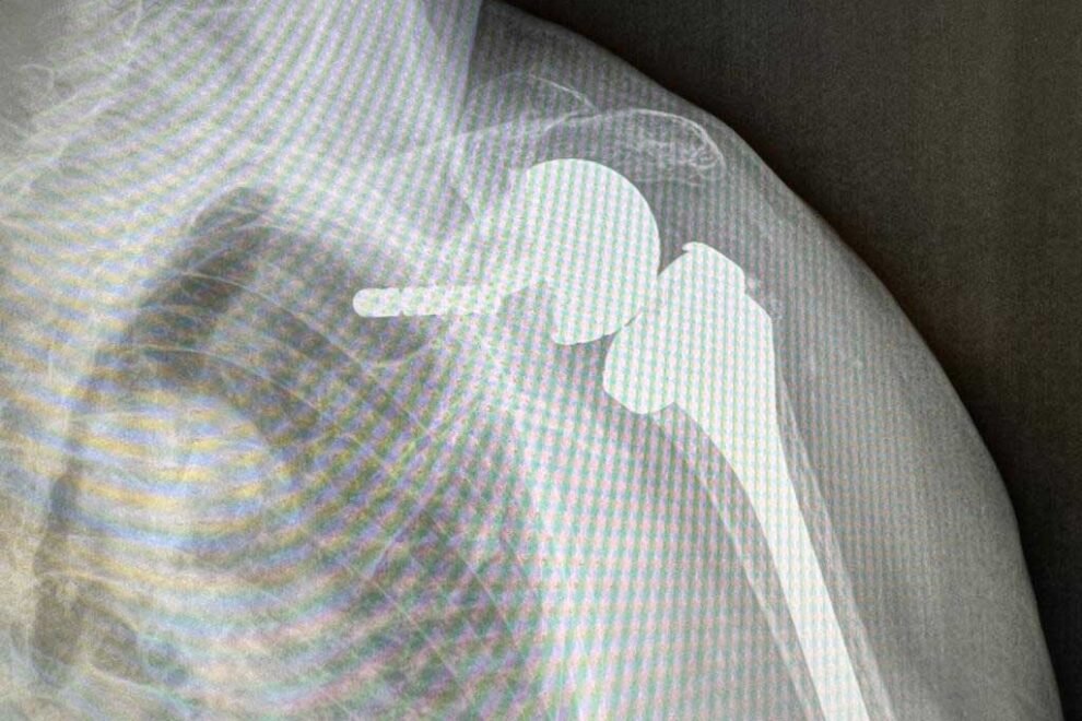 protesi inversa di spalla