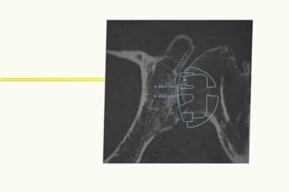 protesi inversa di spalla con navigazione