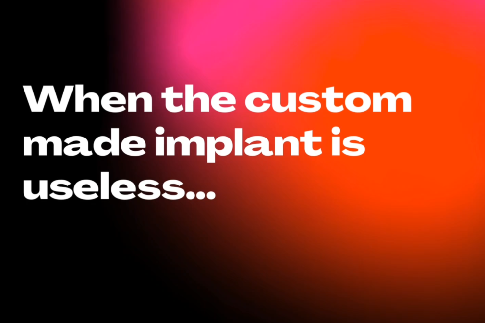 Revisione protesi di spalla Prof. Francesco Fraanceschi ortopedico spalla Roma