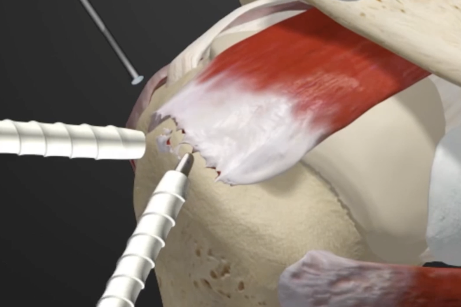 Lesione della cuffia dei rotatori o sovraspinoso