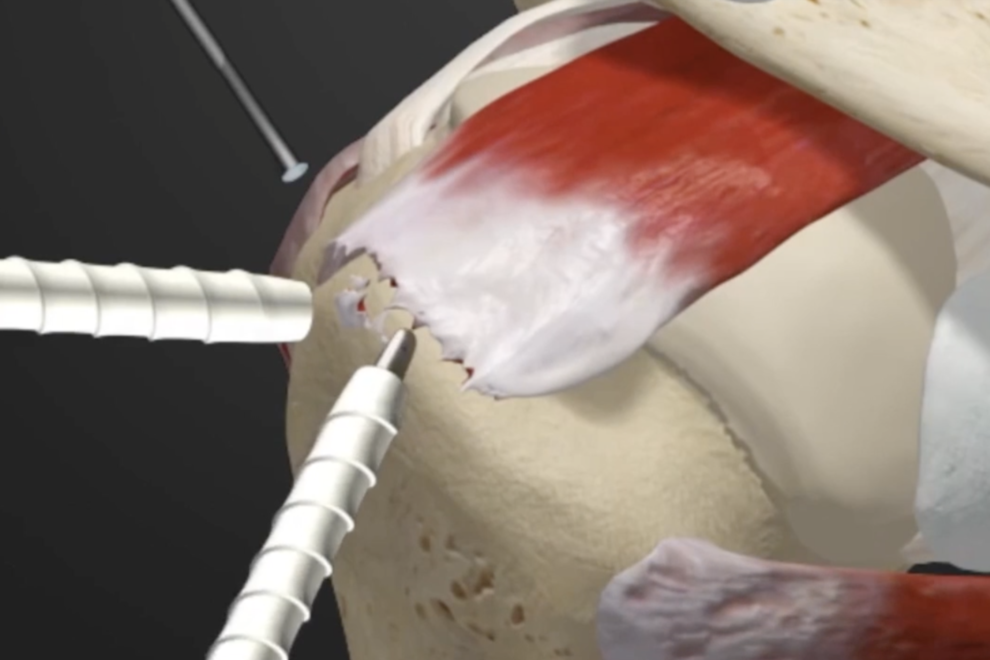 Lesione della cuffia dei rotatori o sovraspinoso