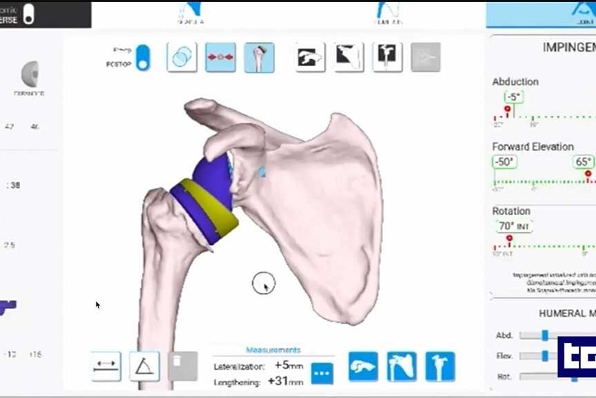 Protesi-della-spalla-intelligenza-artificiale-Prof.-Francesco-Franceschi-ortopedico-spalla-Roma