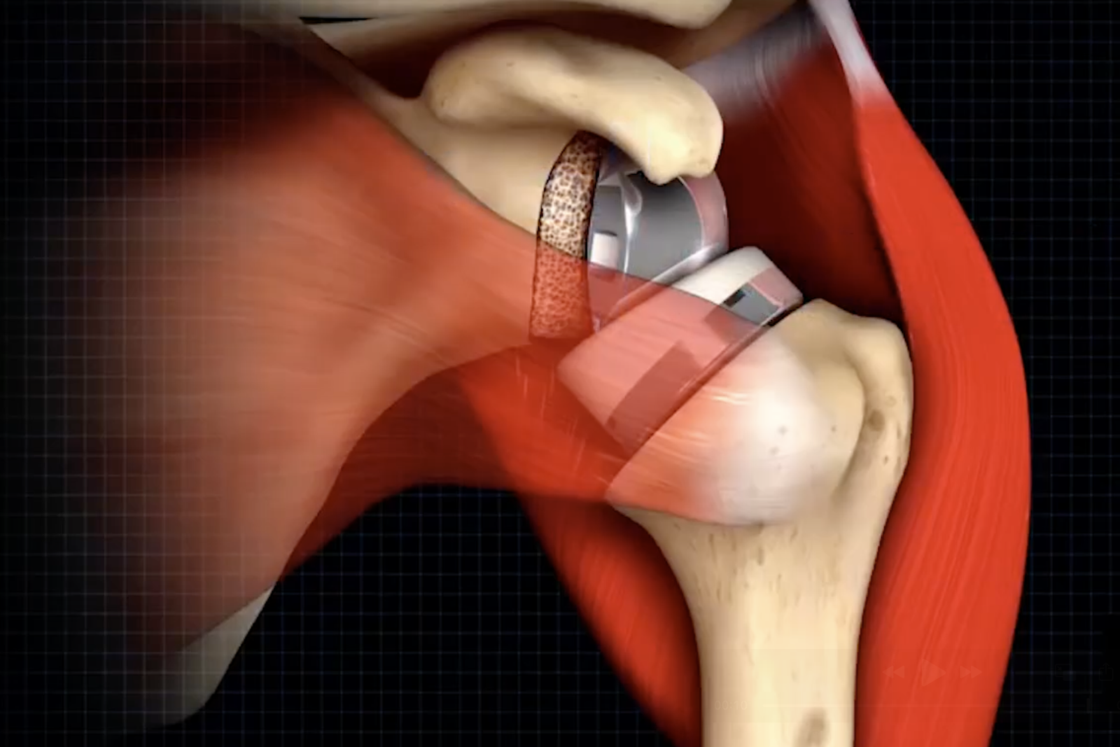 revisione protesi di spalla