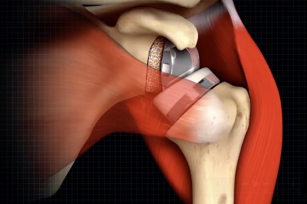 revisione protesi di spalla revisione protesi di spalla